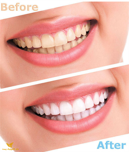 دستگاه سفید کننده و پولیش دندان لوما